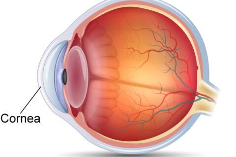 cornea_inset